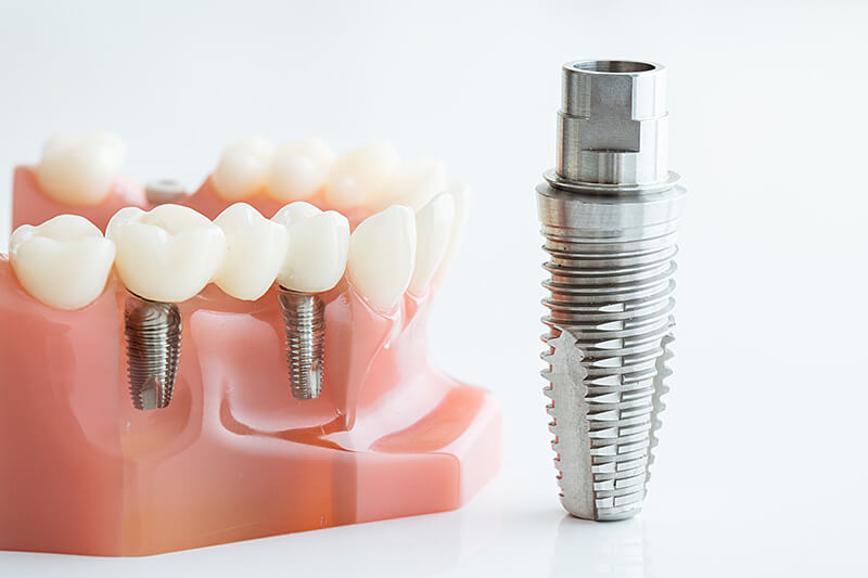 歯のインプラント模型と人工歯根のクローズアップ