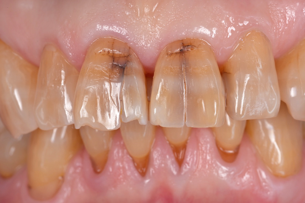 ひび割れた前歯