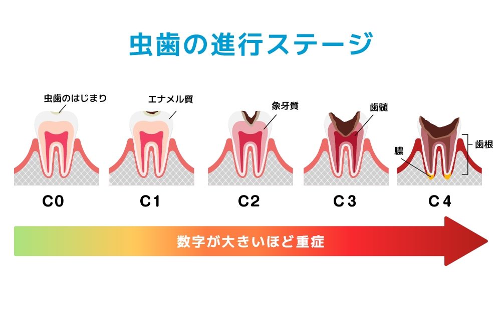 虫歯の進行度を示した図