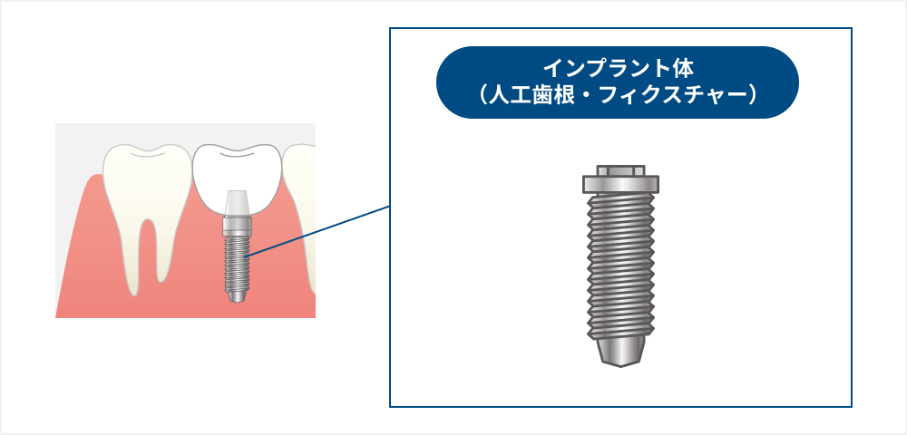 インプラント体