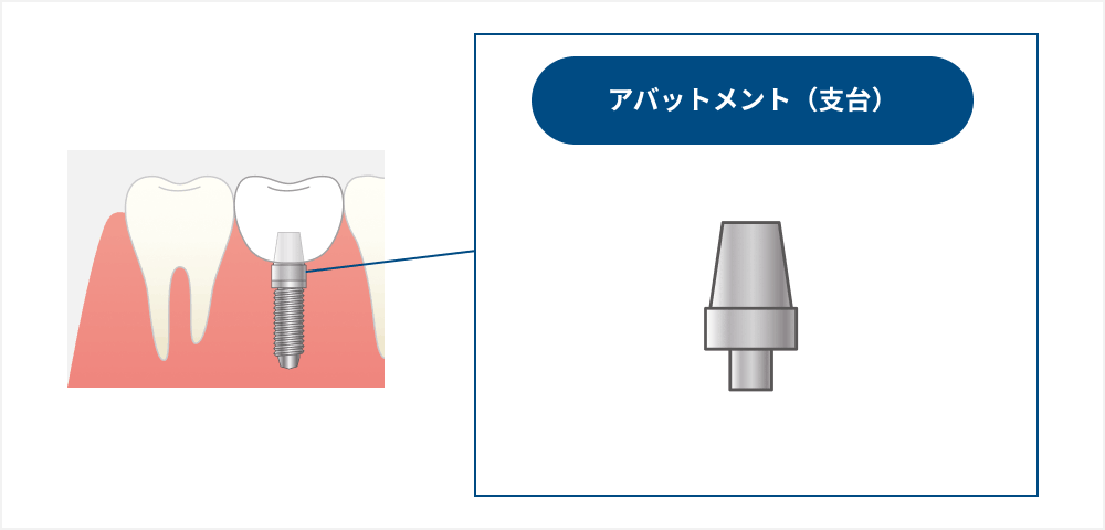 アバットメント（支台）