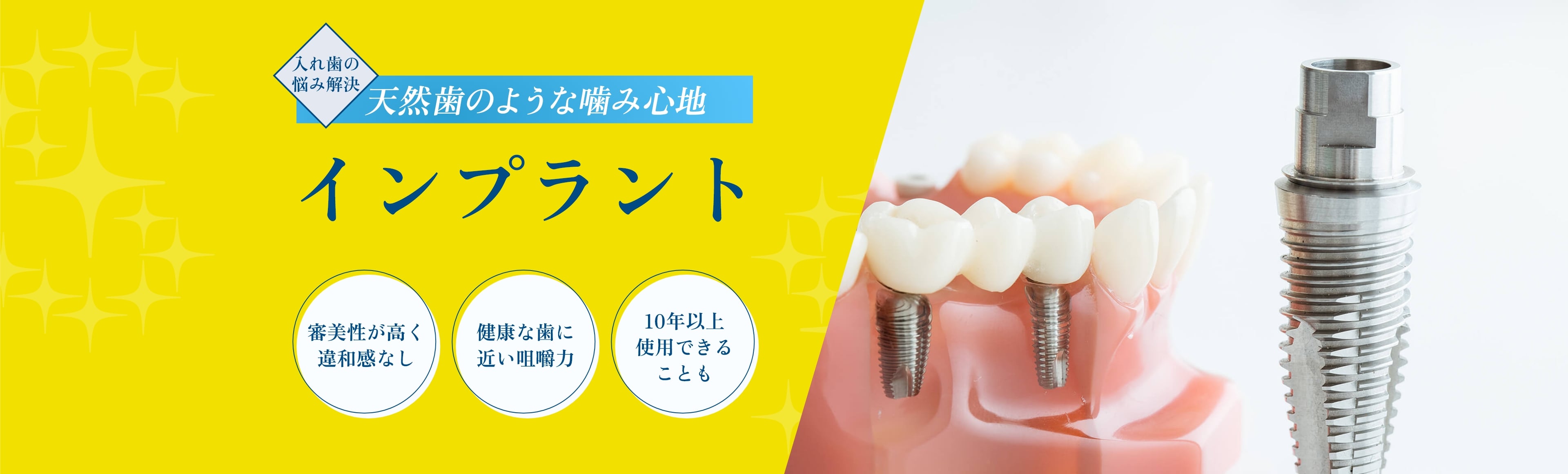 インプラント