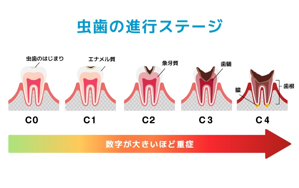 虫歯の進行度