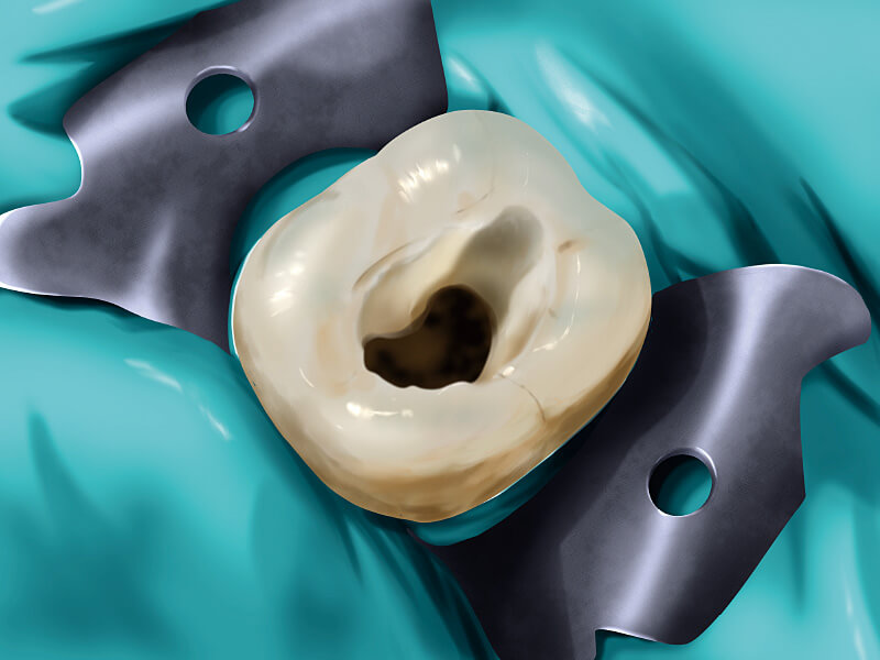 ラバーダム防湿による歯科治療