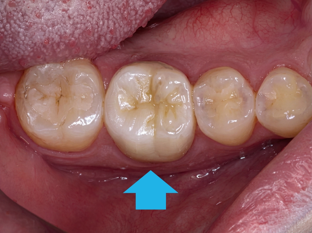 経過観察・土台築造・被せ物治療