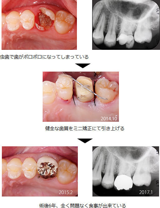 むし歯症例