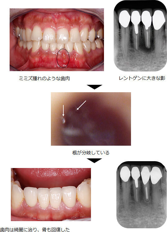 精密根管治療の症例