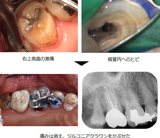 精密根管治療の症例