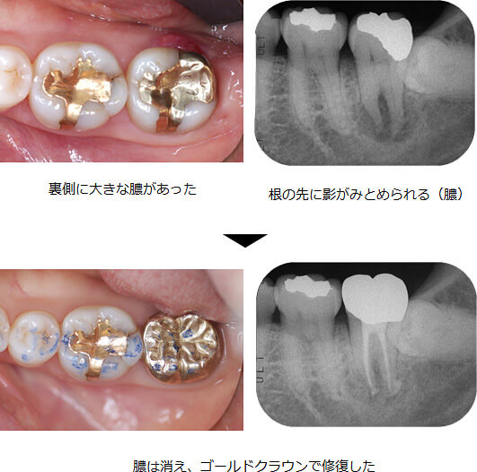 精密根管治療の症例