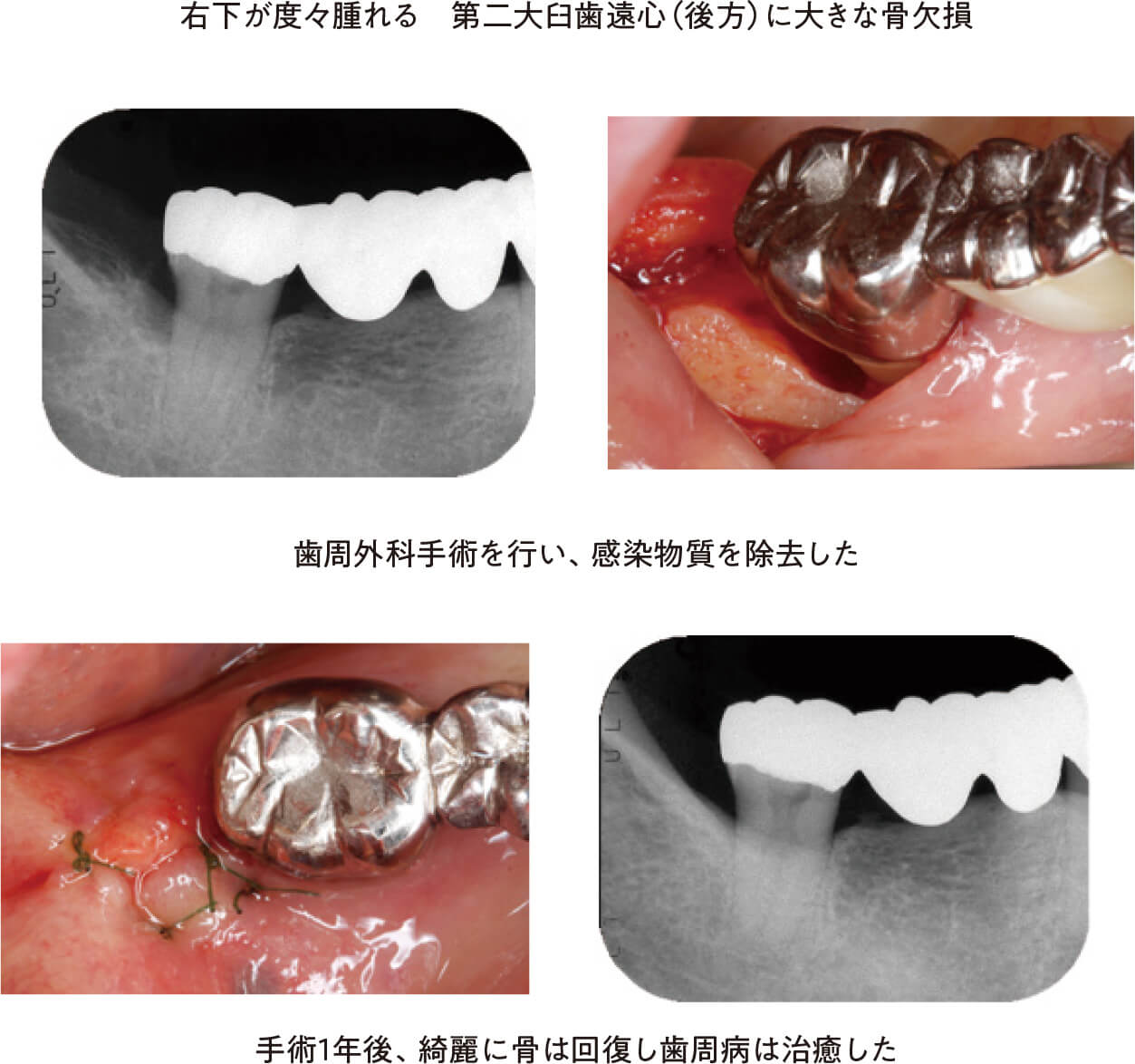 歯周病治療症例