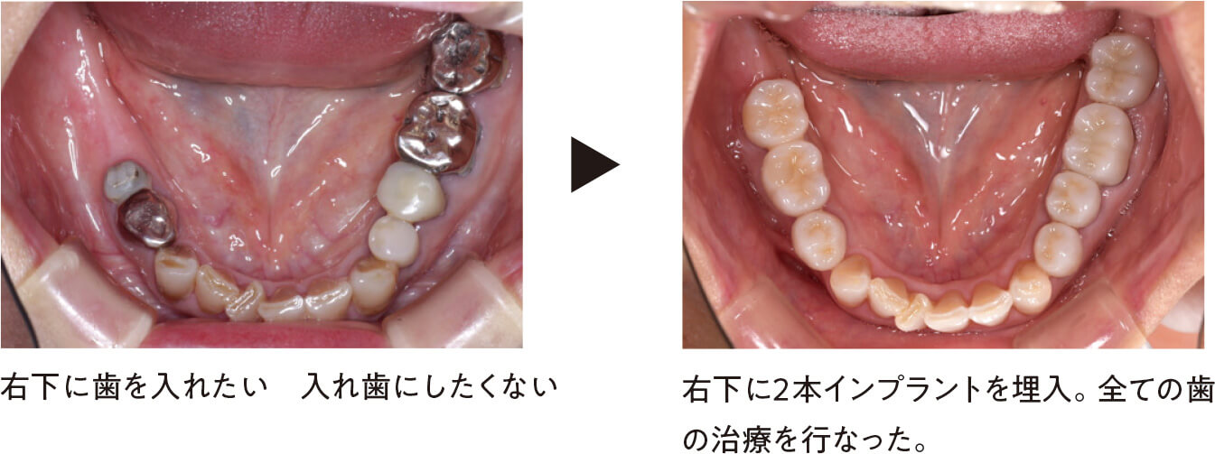 インプラント症例
