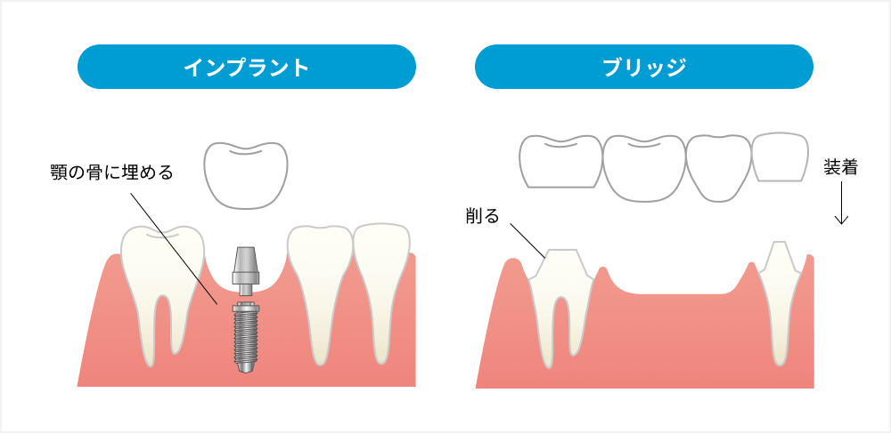 インプラントとブリッジ