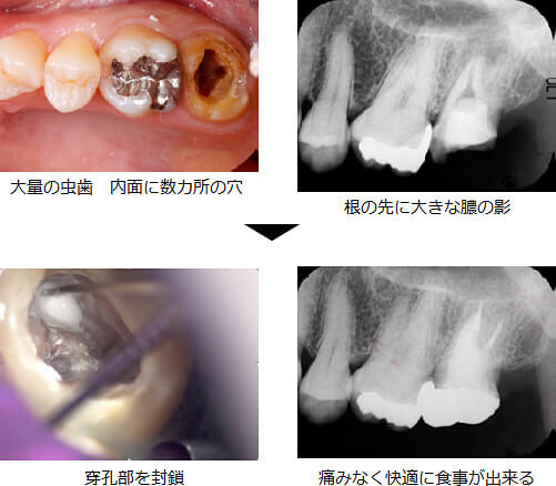 精密根管治療の症例