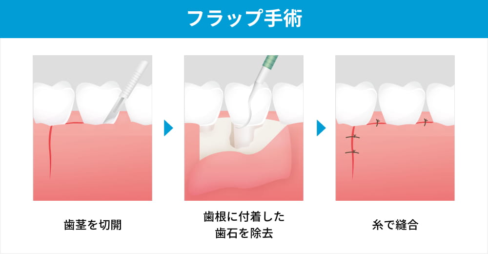 フラップ手術