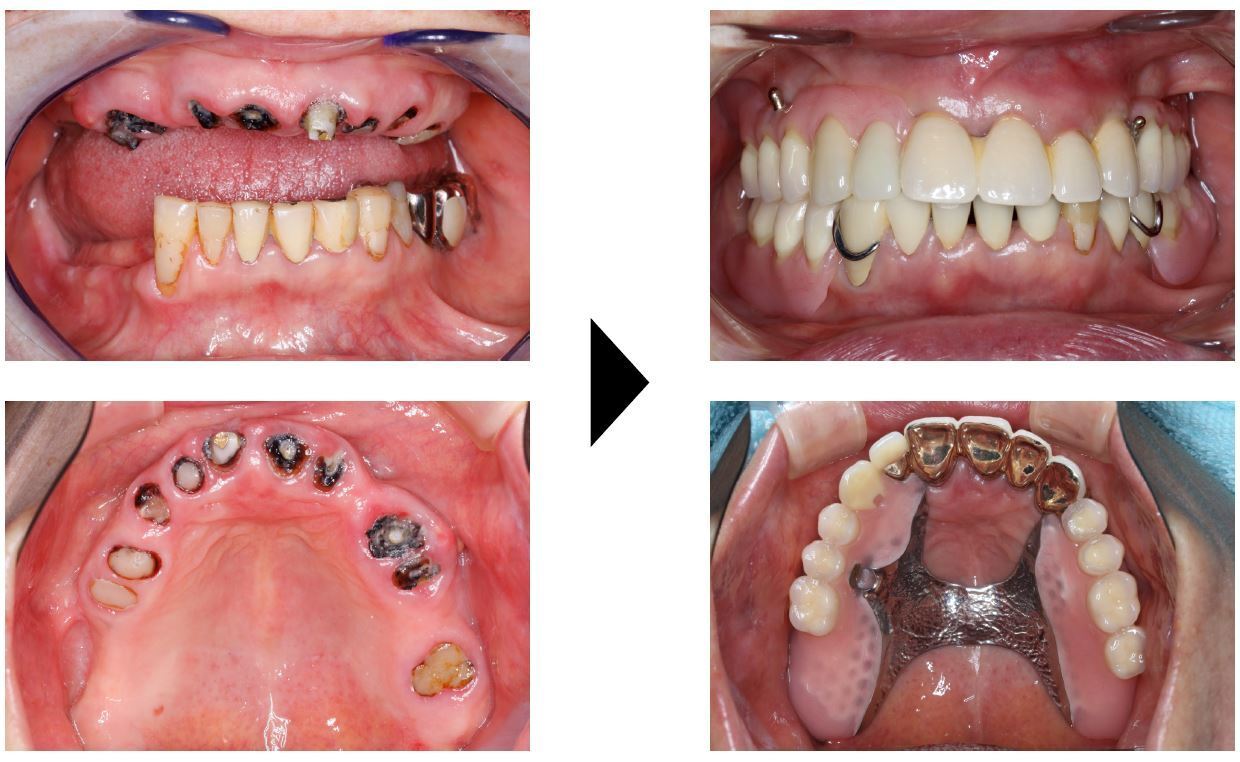 関口歯科 川越、歯医者、歯科医、歯周病、根管治療、入れ歯(義歯)、審美歯科・セラミック治療、自由診療