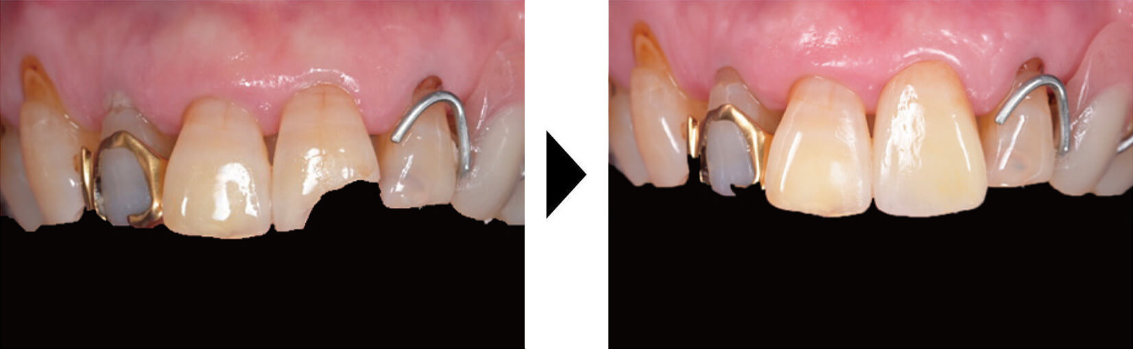関口歯科 川越、歯医者、歯科医、歯周病、根管治療、入れ歯(義歯)、審美歯科・セラミック治療、自由診療