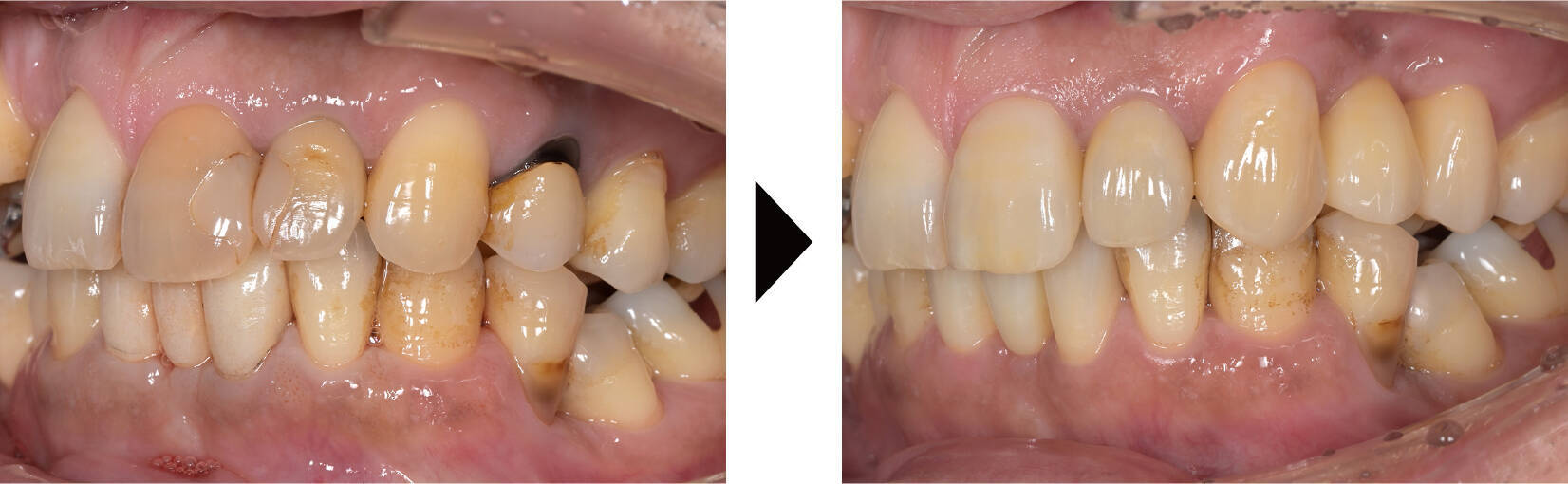 関口歯科 川越、歯医者、歯科医、歯周病、根管治療、入れ歯(義歯)、審美歯科・セラミック治療、自由診療