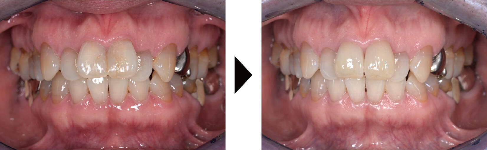 関口歯科 川越、歯医者、歯科医、歯周病、根管治療、入れ歯(義歯)、審美歯科・セラミック治療、自由診療