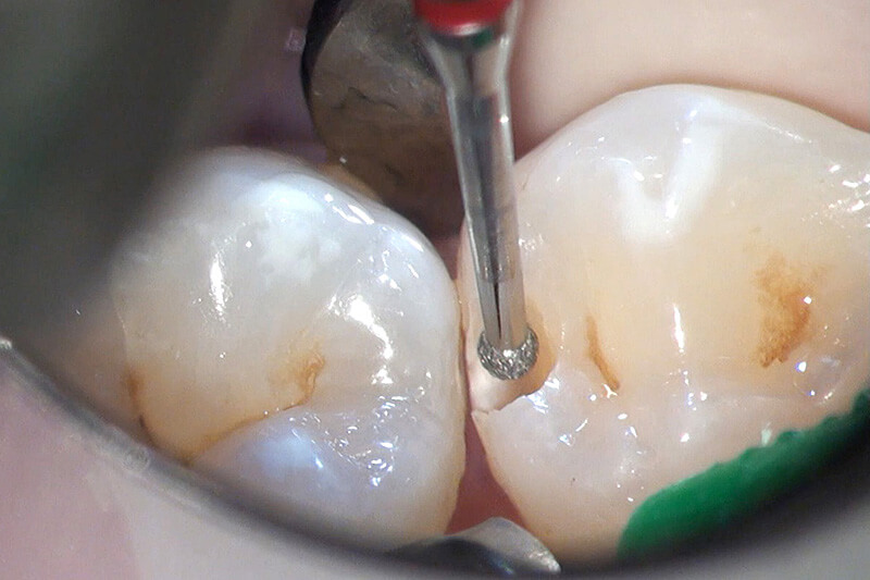 歯科用マイクロスコープ・歯科用顕微鏡治療と他治療との比較