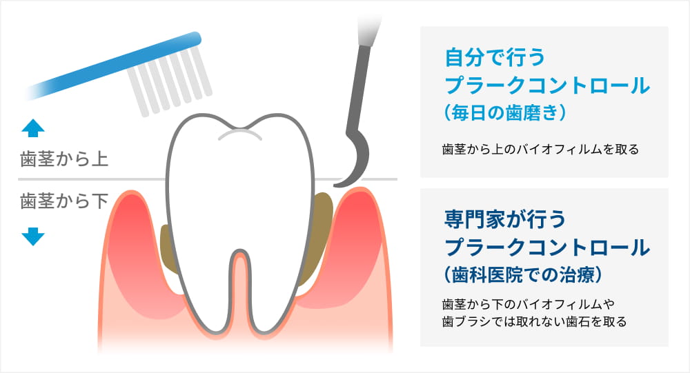 歯周病治療の内容