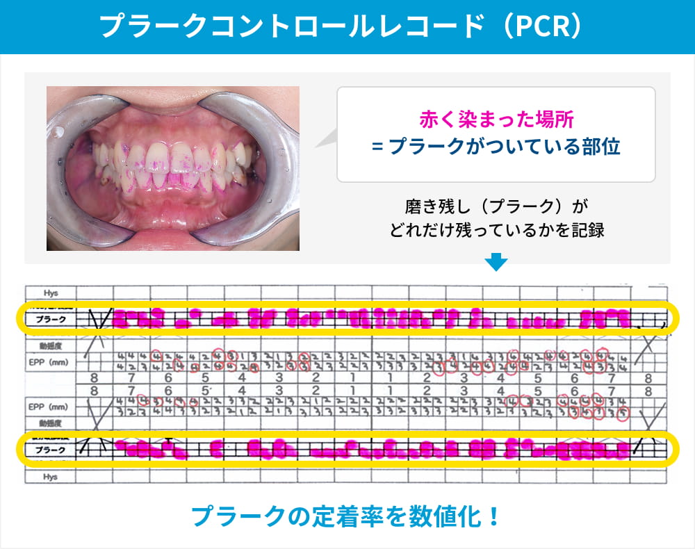 プラークコントロールレコード