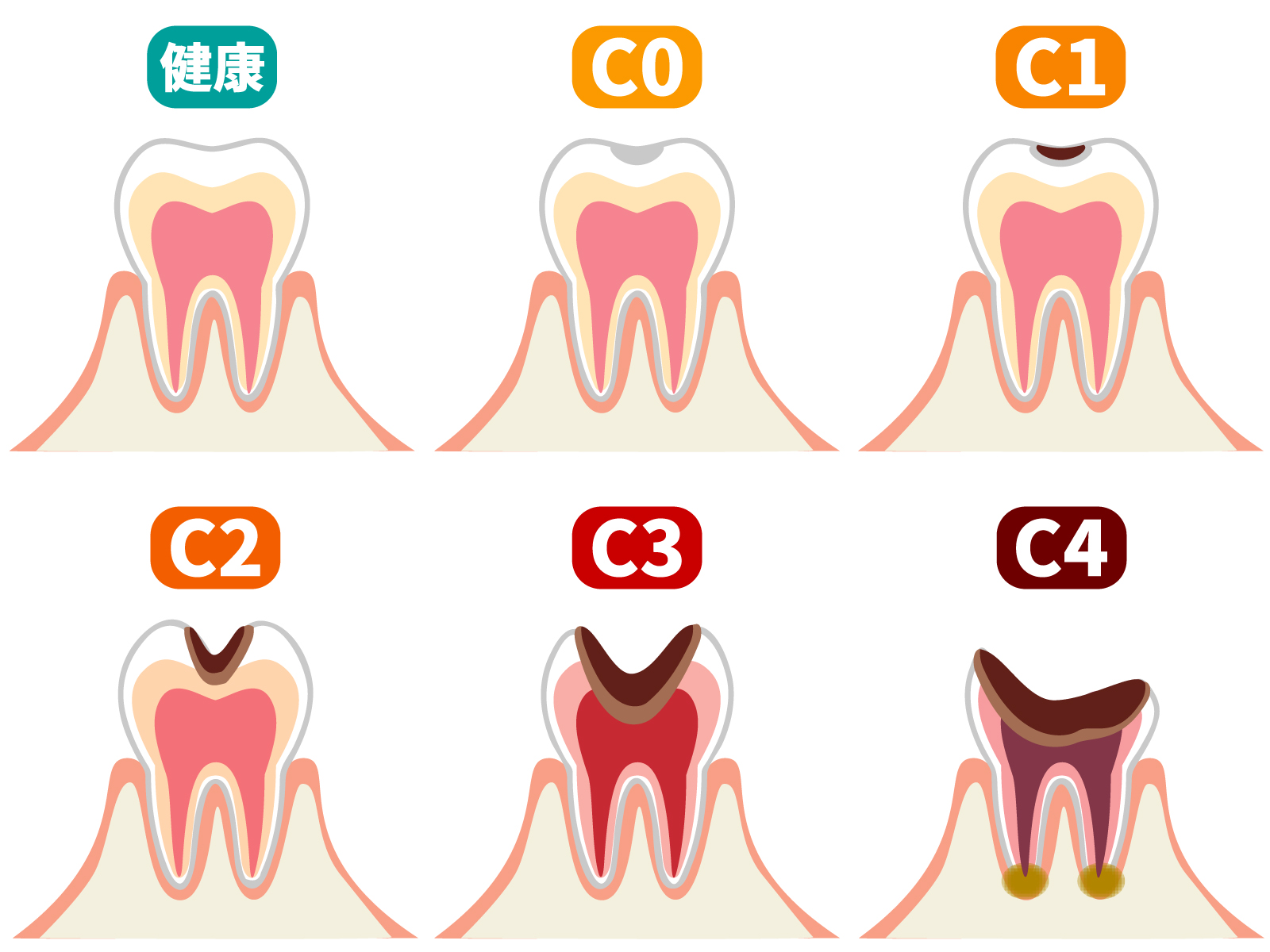 虫歯の進行度