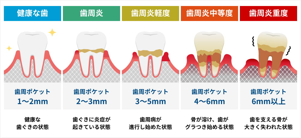 歯周病とは