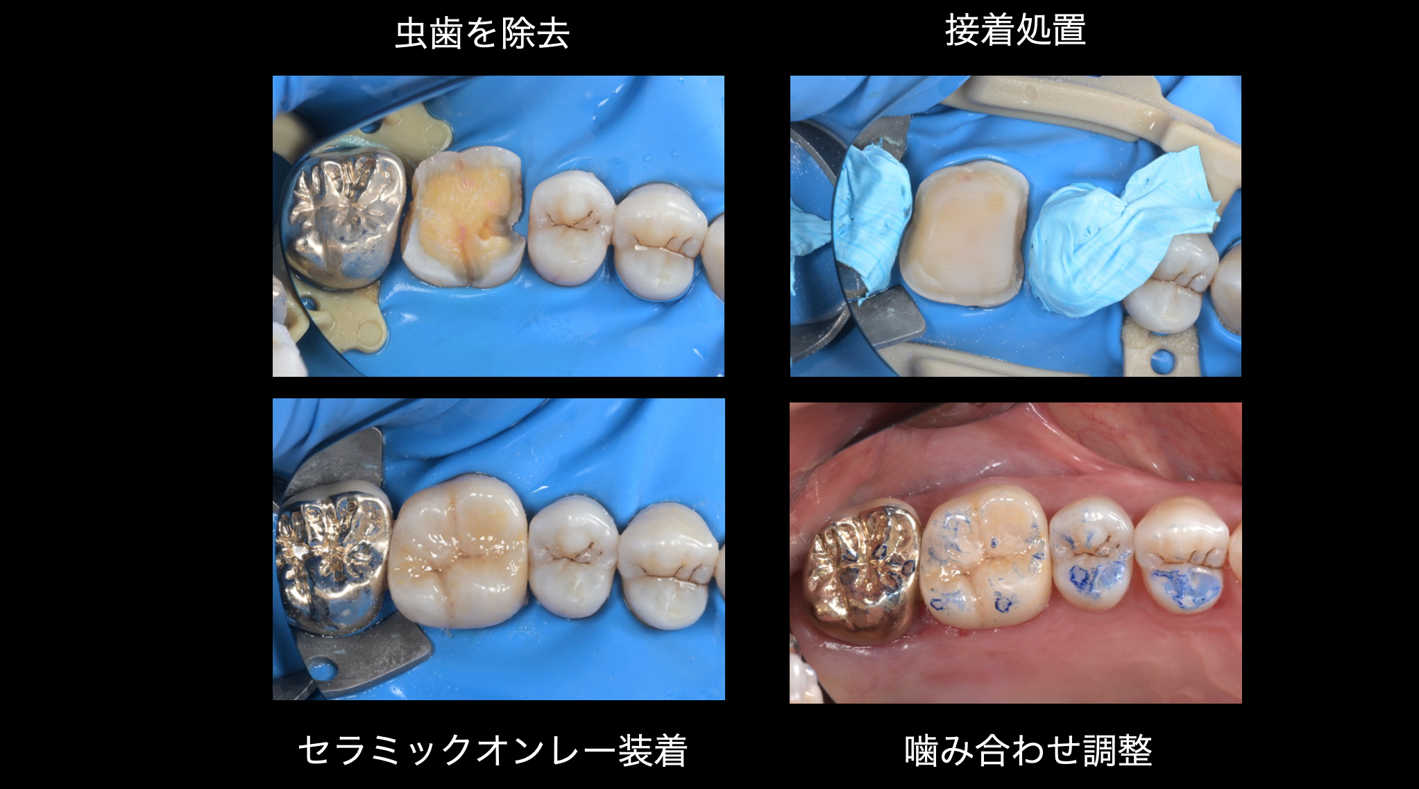 関口歯科 川越、歯医者、歯科医、歯周病、根管治療、入れ歯(義歯)、審美歯科・セラミック治療、自由診療
