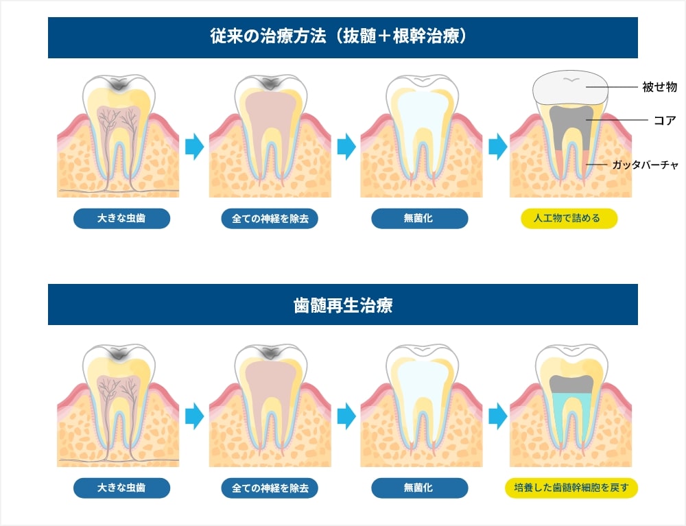 従来の根管治療との比較