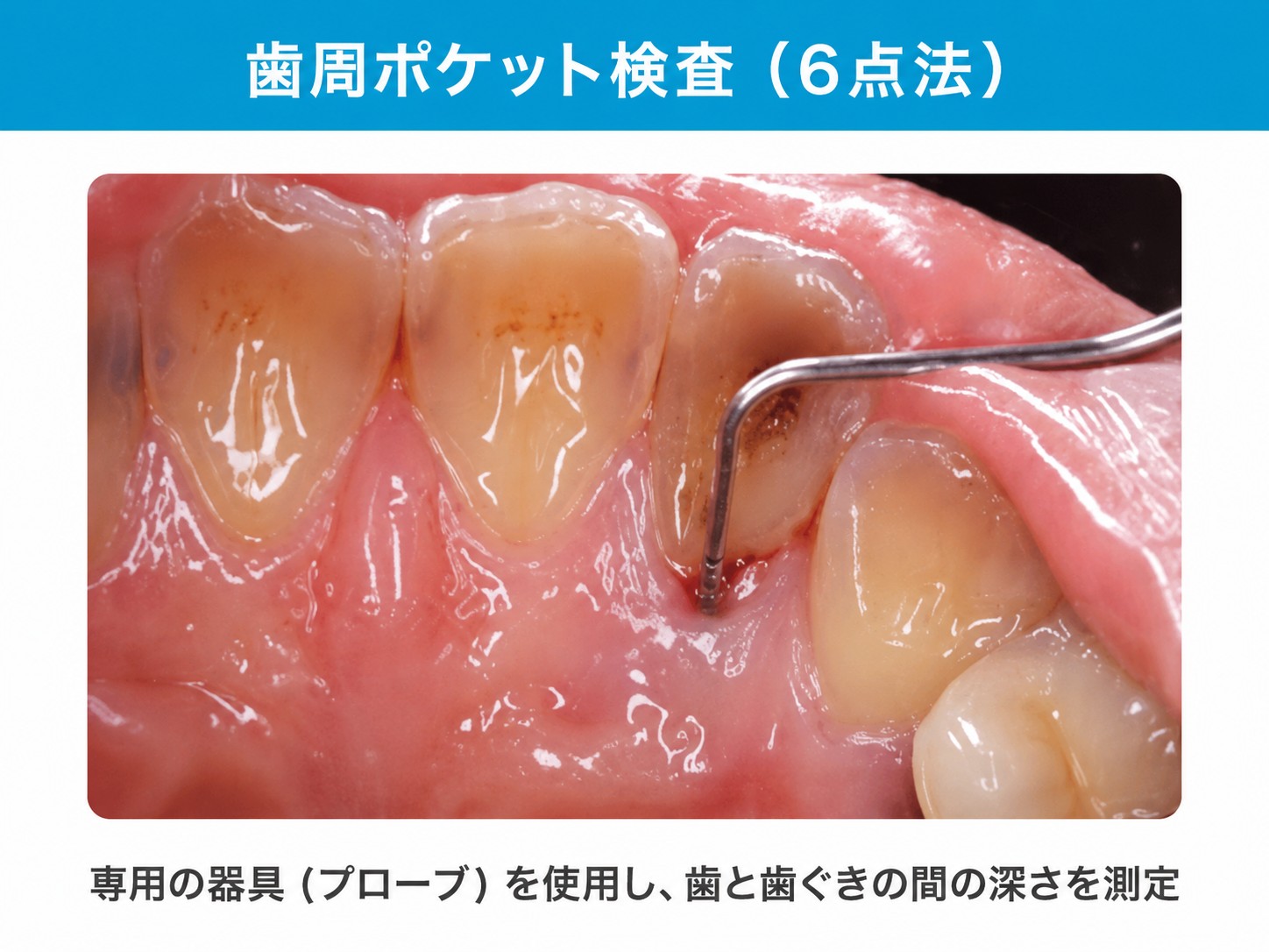 歯周ポケット検査（6点法）