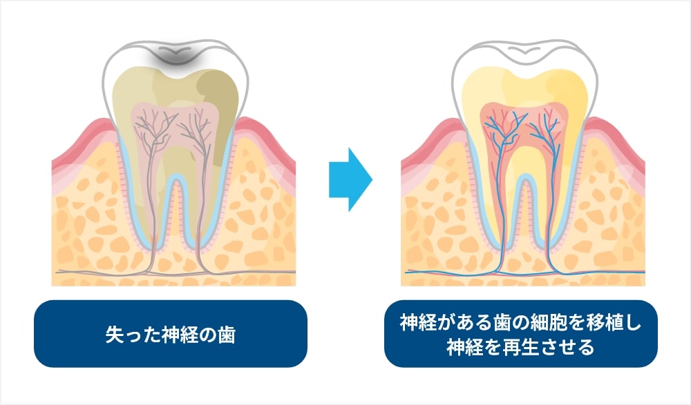 歯髄（歯の神経）再生治療とは？